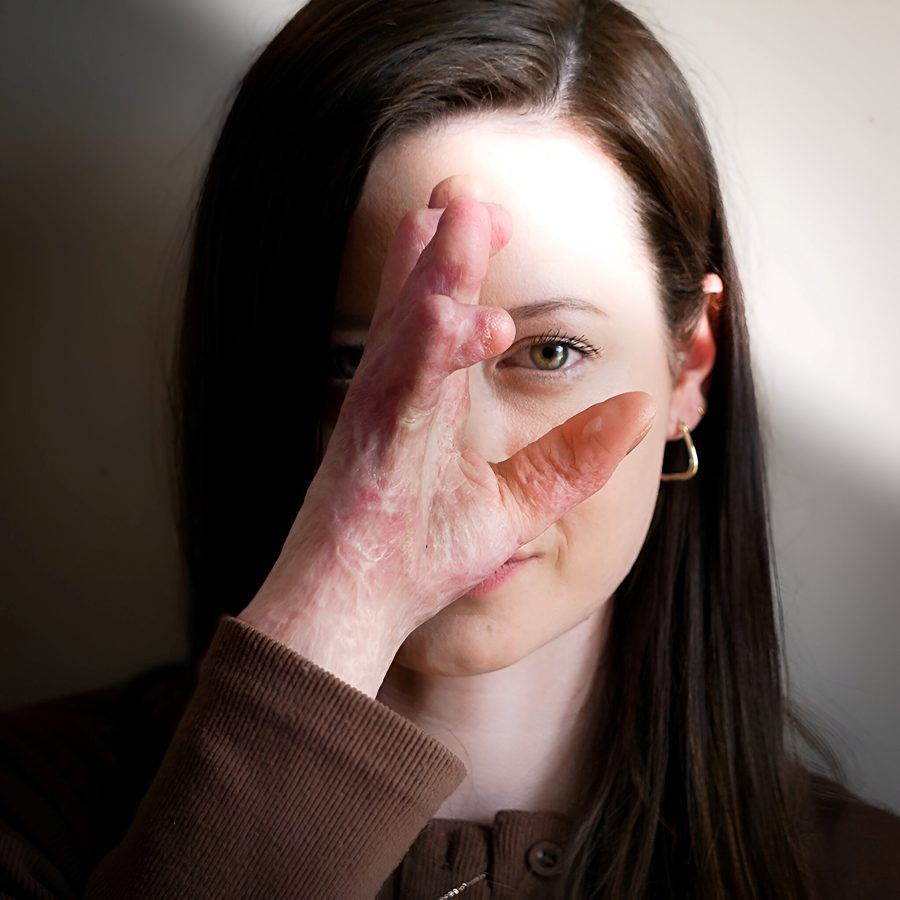  Scarred Stillness by Lucy Wilson  -  Global Ability Photography Challenge 