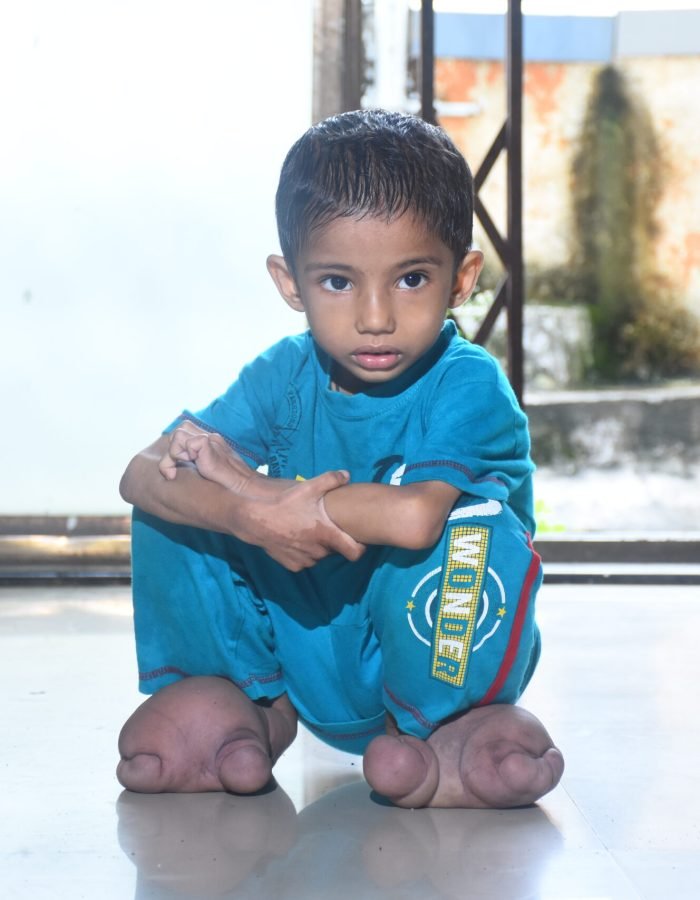 Dipali Rajendra Rajput   | Disability – Person with Locomotor Disability | India